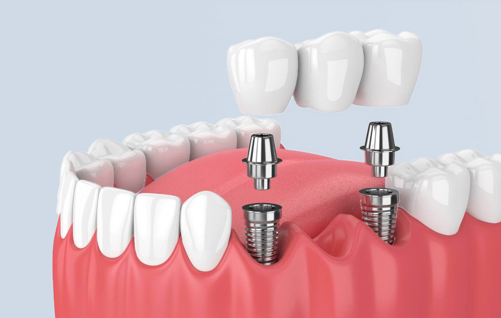 DENTAL İMPLANTLAR