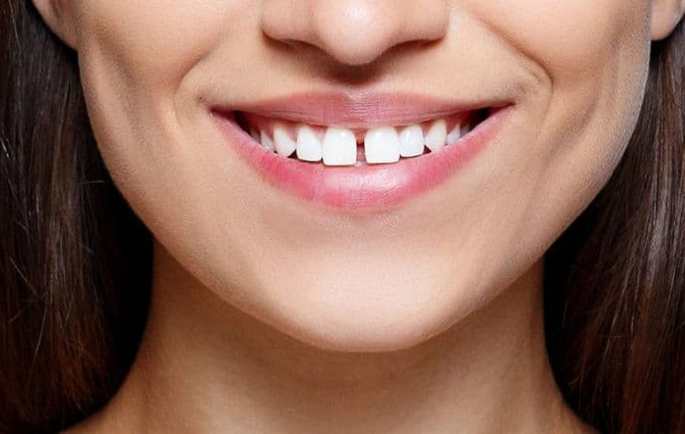 ÖZEL DENT ULUCAN - AĞIZ VE DİŞ SAĞLIĞI POLİKLİNİĞİ DİESTEMA (AYRIK DİŞ) NEDİR? NASIL TEDAVİ EDİLİR?